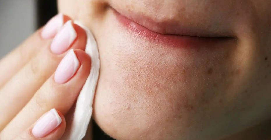 راه های از بین بردن جوش سرسیاه -  آرایشی مهرو