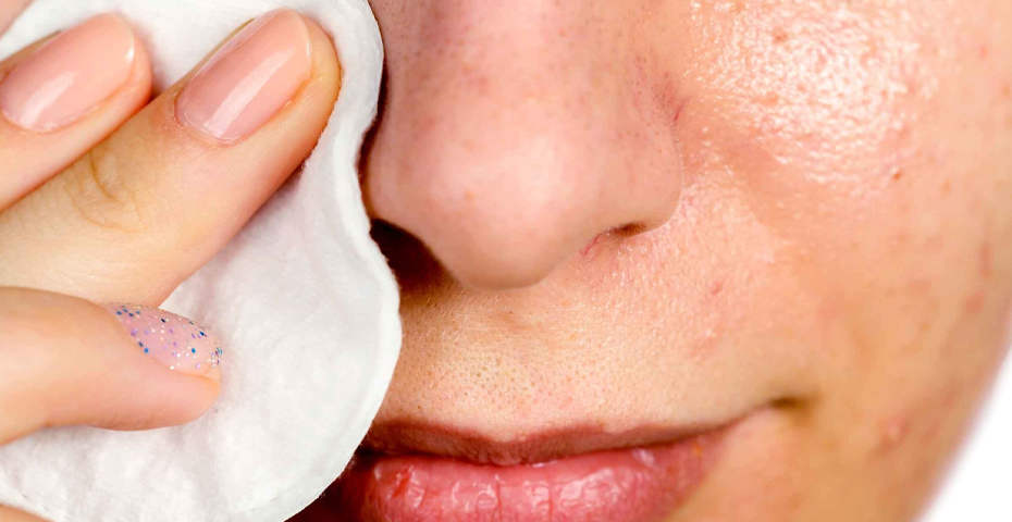 راه های از بین بردن جوش سرسیاه -  آرایشی مهرو